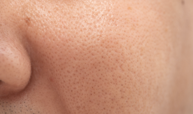 acne-after