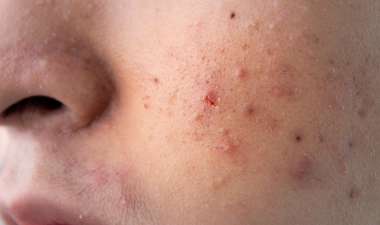 acne-before